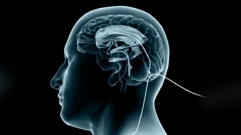 Hydrocephalus Treatment