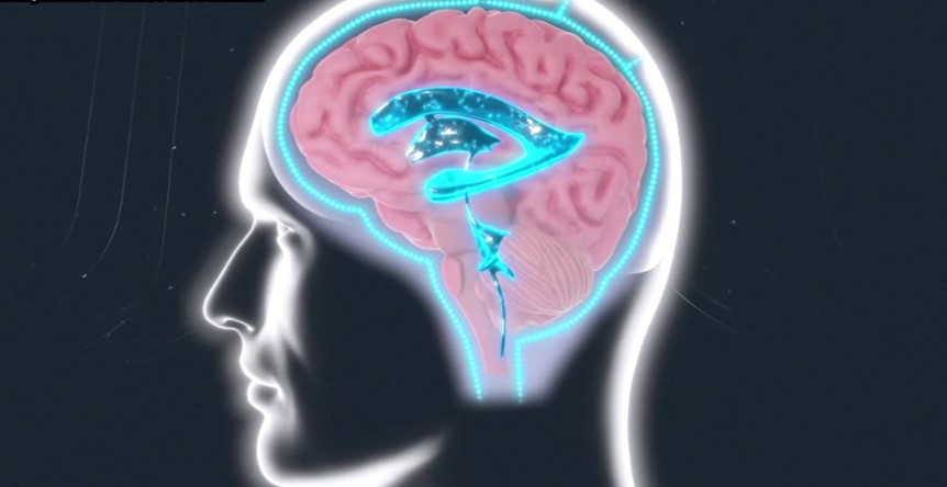 Hydrocephalus Treatment in Sialkot