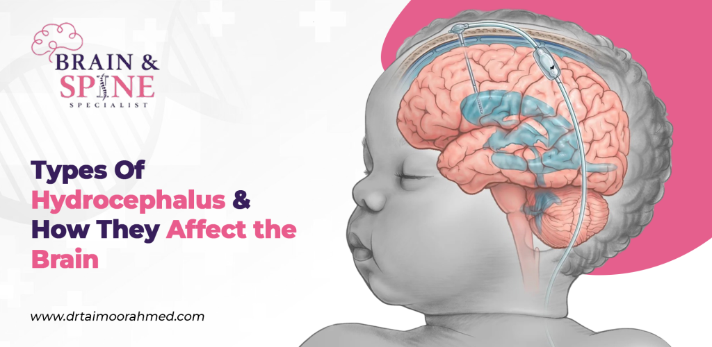 Types Of Hydrocephalus